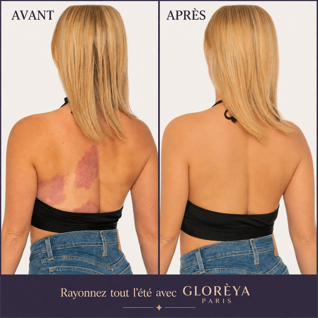 SkinLab PURE™ | Correcteur de teint effet bronzant pour le corps [2+1 OFFERTE!]